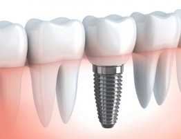 Implantologia Dentale Osteointegrata