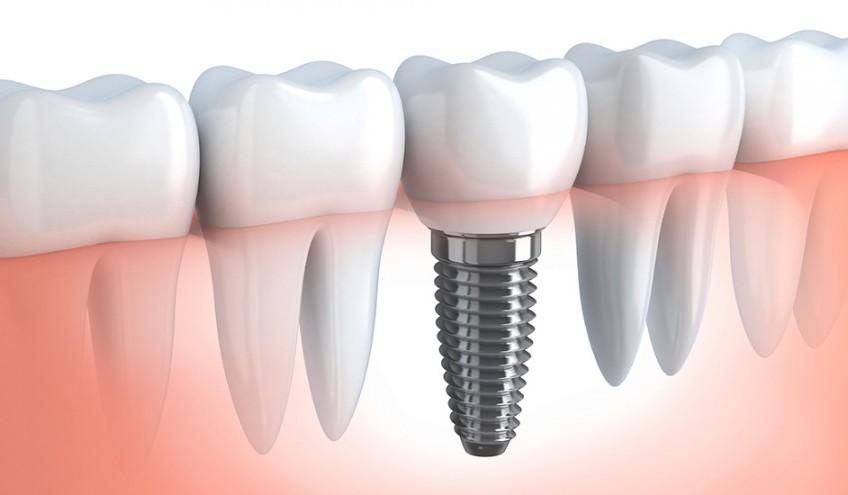 Implantologia Dentale Osteointegrata